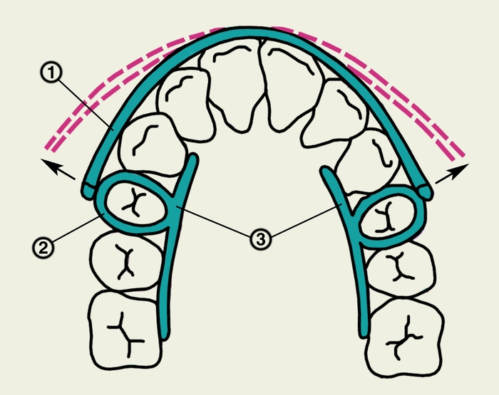 Рис. 4. Схематическое изображение наложения аппарата Эйнсуорта: 1 — упругая дуга; 2 — кольцо для фиксации аппарата на зубах; 3 — касательные балочки; стрелками показано направление силы, развиваемой аппаратом