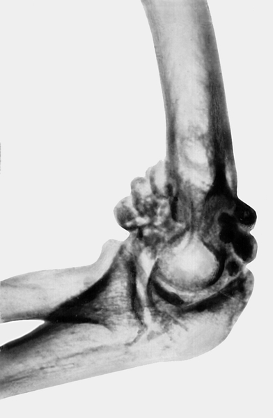 Рис. 12б). Рентгенограмма при хондроматозе локтевого сустава — боковая проекция