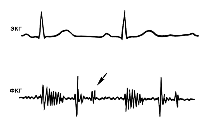 Рис. 4. Фонокардиограмма (с верхушки сердца) больного с недостаточностью митрального клапана: амплитуда I тона снижена, убывающий систолический шум, отчетливый III тон (указан стрелкой). На этом рисунке, а также на рис. 6, 7, 9, 14, 19, 21 фонокардиограммы приведены в обычной для фонокардиографического исследования синхронной записи с ЭКГ