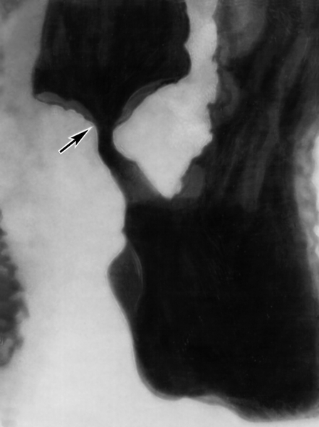 Рис. 5б). Рентгенограмма желудка при эндофитной форме роста рака с ограниченным поражением: сужение и неровность контуров привратниковой части (указаны стрелкой)