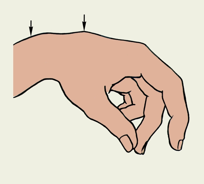 Рис. 5а). Схематическое изображение деформаций пальцев кисти при повреждениях сухожилий сгибателей на различных уровнях: на уровне запястья; уровни повреждения сухожилий указаны стрелками