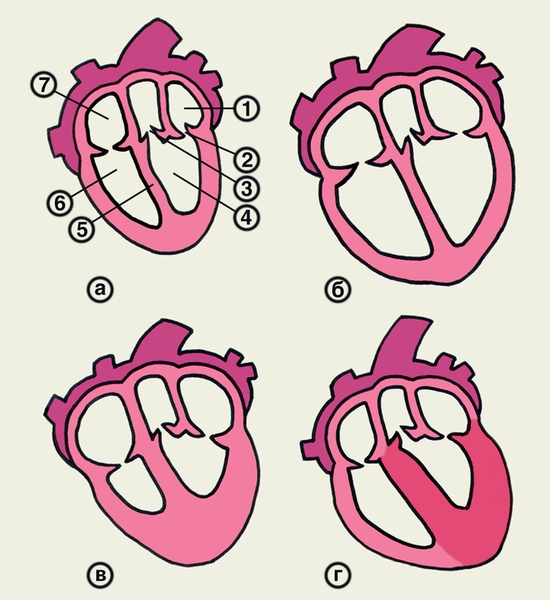 Рис. 1. Схематическое изображение изменений сердца при основных формах кардиомиопатии: а — здоровое сердце (1 — левое предсердие, 2 — <a href=