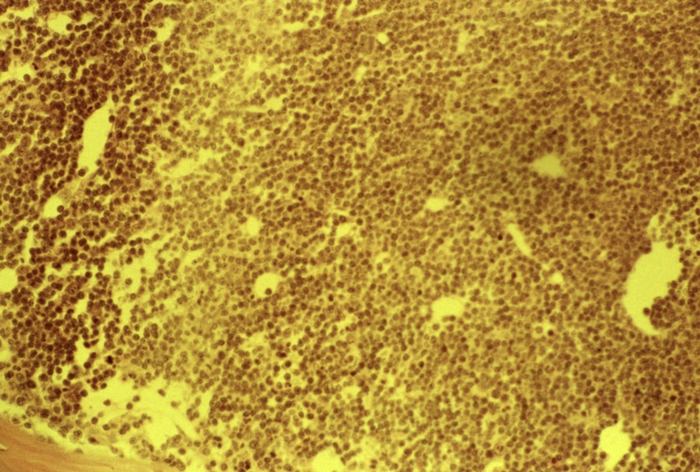 Рис. 8. Микропрепарат печени при хроническом миелолейкозе: внутридольковая лейкозная инфильтрация (1) с нарушением трабекулярной структуры дольки и атрофией гепатоцитов (2). Окраска гематоксилином и эозином; ×280