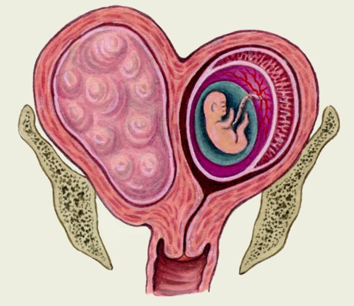 Рис. 5в). Схематическое изображение плода в матке при межмышечном миоматозном узле