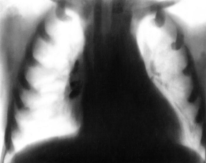 Рис. 3 в). Томограмма в прямой проекции органов грудной клетки при туберкулезе внутригрудных лимфатических узлов: тень корня правого легкого расширена и уплотнена за счет увеличенных лимфатических узлов, на томограмме она имеет бугристые очертания