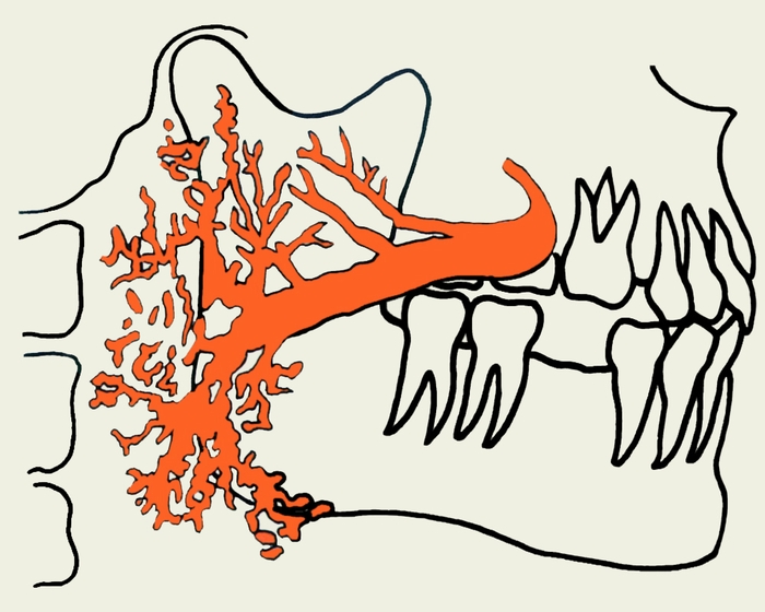 Рис. 1. Схема сиалограммы околоушной железы при хроническом паренхиматозном паротите