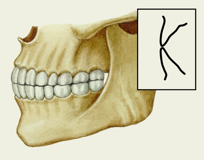 Рис. 1в). Схематическое изображение челюстей при основных разновидностях нормального прикуса (вид сбоку): прямой прикус