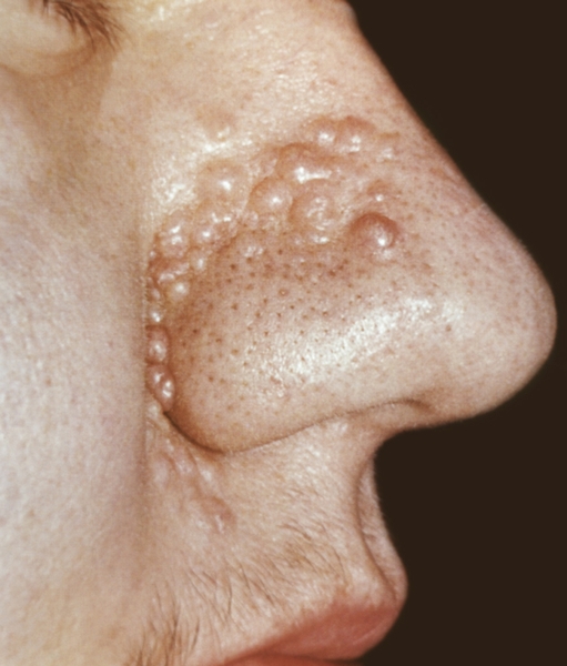 Рис. 5. Трихоэпителиома: множественные мелкие узелки в области носа