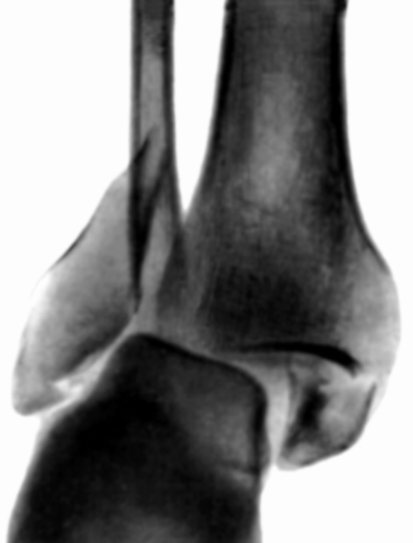 Рис. 4в). Рентгенограмма голеностопных суставов при переломах образующих их костей: перелом наружной и внутренней лодыжек со смещением (прямая проекция)