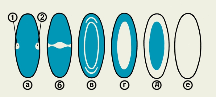 Рис. 4. Схематическое изображение различных форм катаракт: а — полярные передняя (1) и задняя (2); б — веретенообразная; в — слоистая (зонулярная); г — ядерная; д — кортикальная; е — полная; помутнение хрусталика обозначено белым цветом