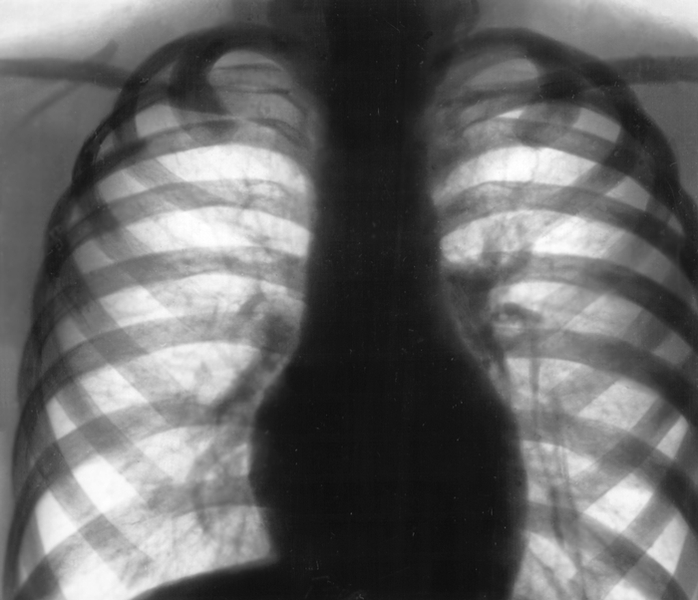 Рис. 4. Обзорная рентгенограмма грудной клетки (прямая проекция) ребенка 7 лет, больного легочной формой муковисцидоза (<a href=