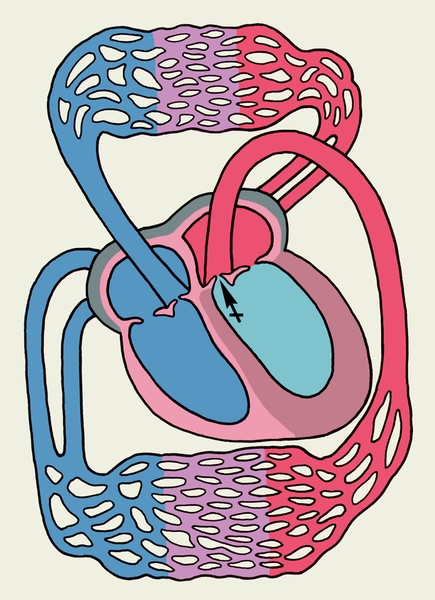Рис. 15. Схема основных изменений сердца при аортальном стенозе (обозначения те же, что на рис. 3): повышение давления в полости левого желудочка, выраженная гипертрофия его миокарда; перекрещенной стрелкой указано место препятствия продвижению крови (стеноз) в систолу