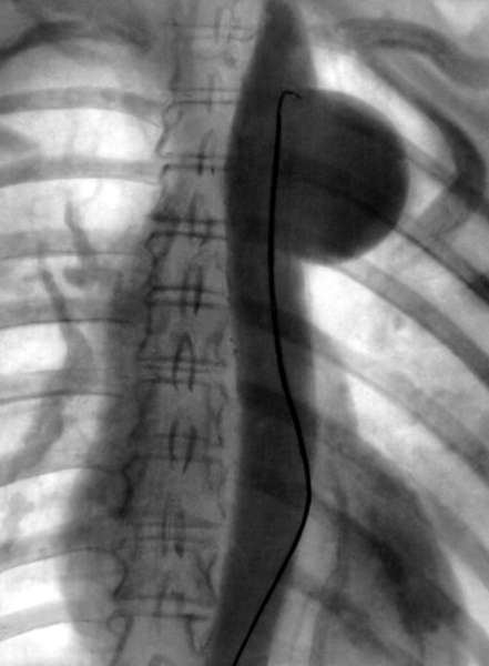 Рис. 2. Аортограмма при мешковидной аневризме грудной части аорты: на фоне контрастированного изображения аорты видно заполненное рентгеноконтрастным веществом мешковидное расширение