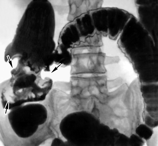 Рис. 5. Рентгенограмма ободочной кишки (при ирригоскопии) больного раком: в восходящем отделе ободочной кишки видны множественные больших размеров дефекты наполнения (указаны стрелками)