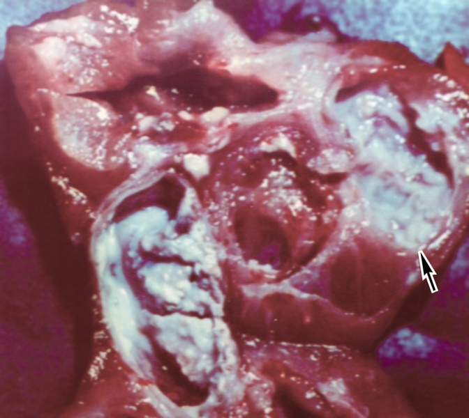 Рис. 8б. Операционный препарат верхнего сегмента правой почки на разрезе при кавернозном туберкулезе почки: видны крупные каверны (указаны стрелкой), заполненные казеозно-гнойными массами