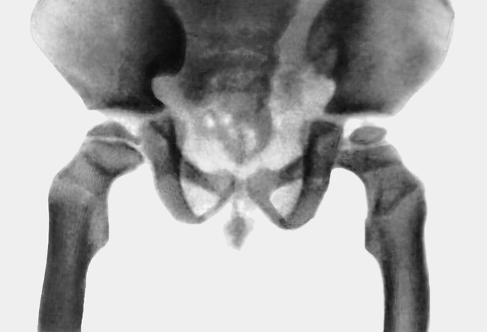 Рис. 2б). Рентгенологические признаки синдрома Гурлер — деформация таза и бедренных костей