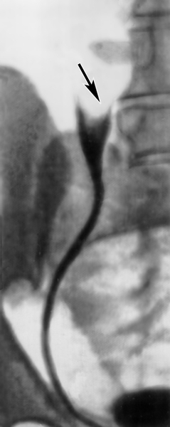 Рис. 9. Экскреторная урограмма при папиллярном раке правого мочеточника: стрелкой указан дефект наполнения, обусловленный опухолью