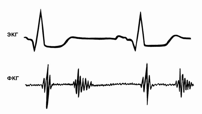 Рис. 14. Фонокардиограмма (с точки Боткина — Эрба) больного с аортальной недостаточностью: снижение амплитуды II тона, протодиастолический шум
