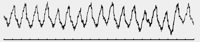 Рис. 4. ЭКГ при трепетании желудочков: внизу — отметчик времени (0,1 с)