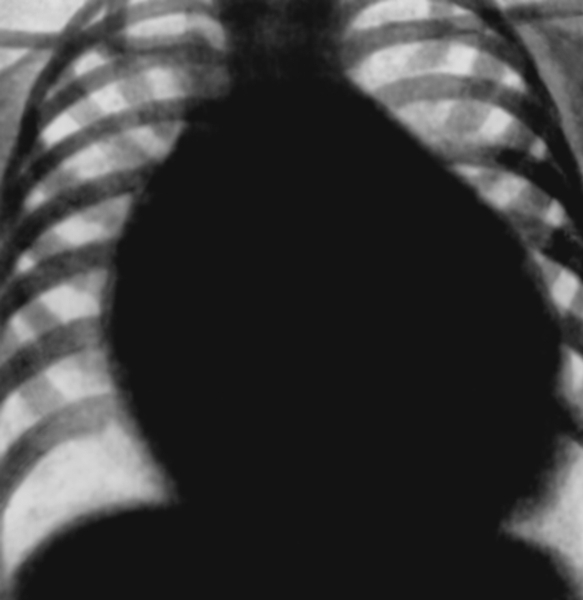 Рис. 28. Рентгенограмма грудной клетки больного при полной форме атриовентрикулярного канала (прямая проекция): контуры сердца округлой формы за счет увеличения правых и левых отделов