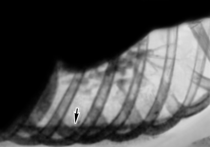 Рис. 2. Рентгенограмма органов грудной клетки больного с левосторонним плевритом (латеропозиция): выпот образует пристеночную лентовидную тень (указано стрелкой)