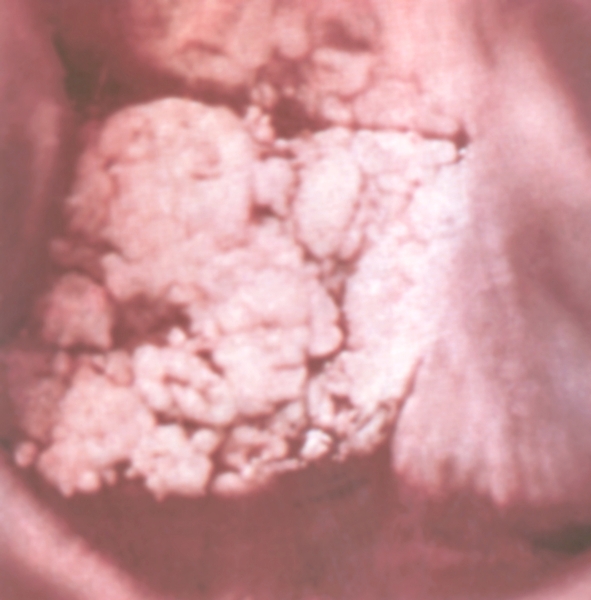 Рис. 8. Кольпоскопическая картина при экзофитном раке шейки метки (стадии Т1в)
