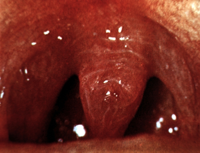 Вид зева при катаральной ангине