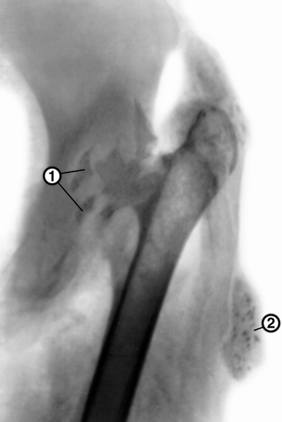 Рис. 5. Рентгенограмма левого тазобедренного сустава (переднезадняя проекция) при туберкулезном коксите в постартритической фазе: <a href=