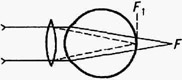 Ход лучей в глазу при дальнозоркости (сплошная линия) и исправление его собирательной линзой (пунктир)
