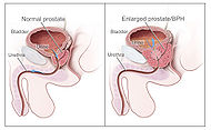 Benign Prostatic Hyperplasia nci-vol-7137-300.jpg