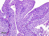 Bladder urothelial carcinoma (1) pT1.JPG