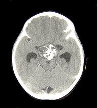 Craniopharyngioma1.jpg