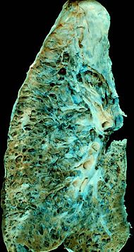 End-stage interstitial lung disease (honeycomb lung).jpg