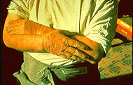 Hands damaged by kerosene.jpg