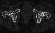 Osteopoikilie Huefte CT.jpg