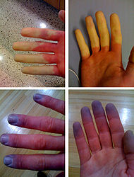 Raynaud's Syndrome.jpg