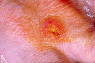 Tularemia lesion.jpg