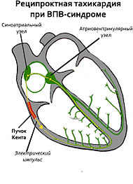WPW tachycardia.jpg