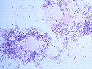 Bacterial vaginosis.jpg