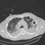 CT chest in pneumonia with abscesses caverns and effusions d0.jpg