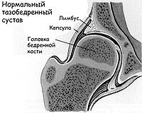 Congenital dislocation of the hip5-1.jpg