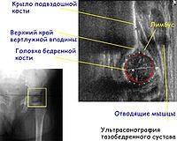 Congenital dislocation of the hip 5.jpg
