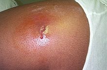 A person’s thigh with a red area that is inflamed. At the centre of the inflammation is a wound with pus.