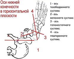 Congenital dislocation of the hip13.jpg