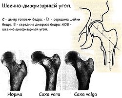 Congenital dislocation of the hip5-4.jpg