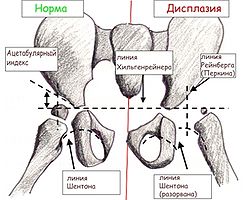 Congenital dislocation of the hip 2.jpg
