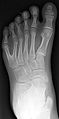59px Polydactyly 01 Lfoot AP