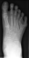 60px Polydactyly 01 Rfoot AP
