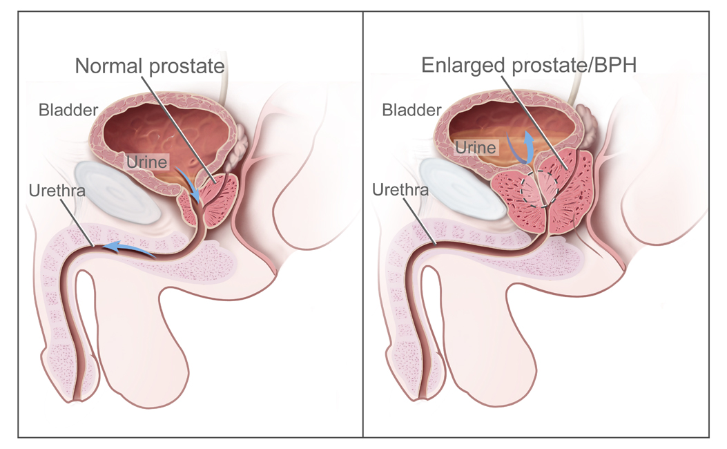 boala coloanei vertebrale prostatita cronică poate o durere de cap cu prostatita