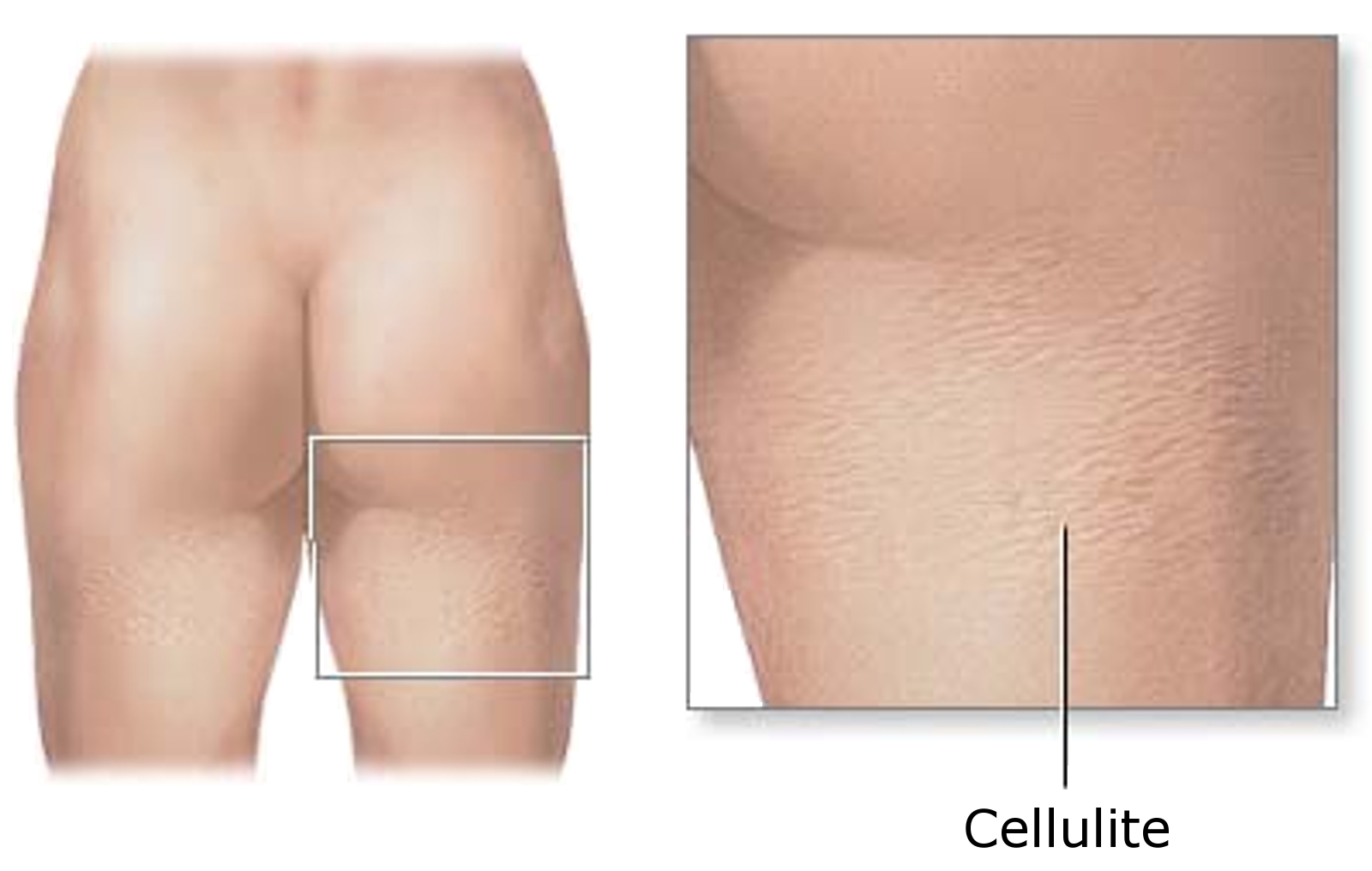 http://dic.academic.ru/pictures/wiki/files/67/Cellulite-2.jpg